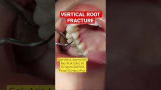 GIGI PATAH SEPAROH ‼️VERTICAL ROOT FRAKTUR gigipatah fracture doktergigiwawansumantri [upl. by Asikal]