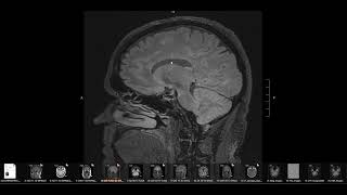 What does MS multiple sclerosis look like on brain MRI Avoid wrongful diagnosis [upl. by Leahcin]