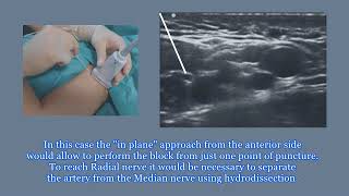 Ultrasound Guided Axillary Block Tutorial [upl. by Eilliw]