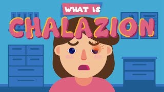 What is Chalazion [upl. by Ynnep253]