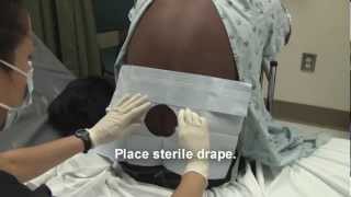 Adult Spinal Tap Procedure Video [upl. by Jilly]