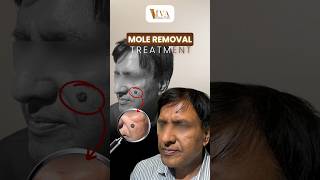 Mole Removal in Just 1 Session Is Now Possible  Dr Deepam Shah [upl. by Aisatal858]