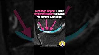 Fig 5C09 MRI Findings of Autologous Chondrocyte Implantation [upl. by Timi]