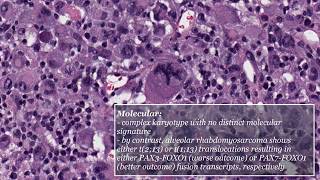 Pleomorphic Rhabdomyosarcoma [upl. by Poore]