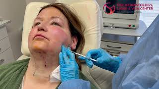 Masseter Botox Injections Reshape Your Jawline and Relieve Jaw Tension  Dr Shalini Gupta [upl. by Atirak]