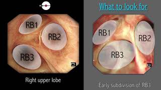 Mastering Bronchoscopy for Thoracic Surgery Chapter 2 [upl. by Maxama]