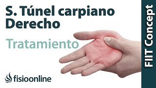 Tratamiento del síndrome de túnel carpiano derecho [upl. by Rizzi]