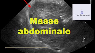 Masse abdominale [upl. by Marienthal566]