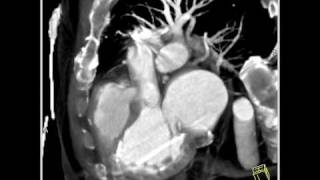 VascularCardiac3D mapping demonstrates extensive coronary artery disease2 of 6 [upl. by Schlessel]