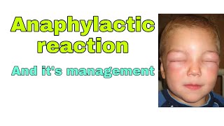 Anaphylactic reaction during general anaesthesia and its management [upl. by Leira154]