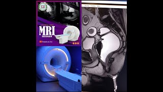 MRI Defecography patient position and preparation on Philips 3T [upl. by Wetzell]