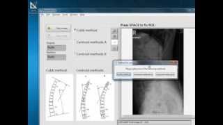 Measuring the Kyphotic Angle in Radiography [upl. by Seldan526]