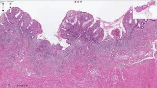 Ulcerative Colitis  Histopathology [upl. by Anirrehs]