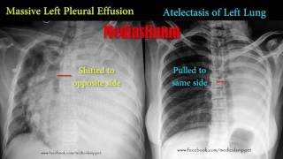 Pleural Effusion Empyema Pneumothorax  Respiratory Course [upl. by Pollie]