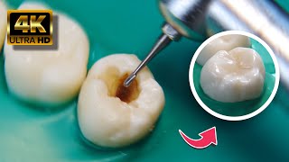 IMPRESIONANTE restauración dental en 4K [upl. by Ilyse]