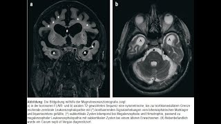 Megalenzephale Leukoenzephalopathie mit subkortikalen Zysten bei einem Erwachsenen [upl. by Havot]