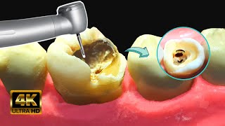 Caries GIGANTE con HONGOS en 4k  Tratamiento de conducto [upl. by Adiazteb]