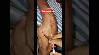 Iv catheter insert  intracath kaise lagaye  jelco kaise lagate shorts ivcannula [upl. by Norehc]