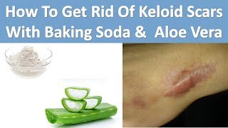 How To Get Rid Of Keloid Scars With Baking Soda amp Aloe Vera [upl. by Demeyer]