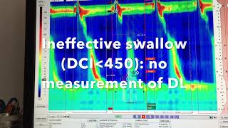 Analysis of Esophageal High Resolution Manometry ESNM Teaching Video [upl. by Hooge]