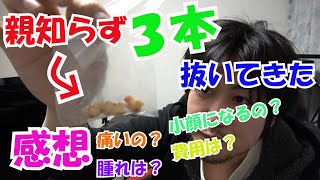 「抜き歯」親知らず3本同時で抜いてきた！ 「感想」痛すぎたw [upl. by Nolyar385]