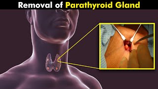 How Parathyroid Gland Surgery Is Performed UrduHindi [upl. by Aeneas377]