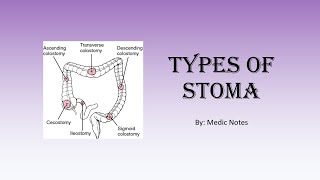 Types of stoma  colostomyileostomyurostomy endloopdoublebarrel temporarypermanent [upl. by Souza]