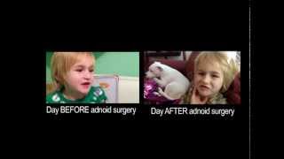 How does adenoid surgery effect a childs voice [upl. by Arlynne]