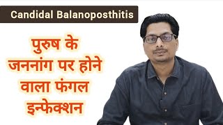 Candidal Balanoposthitis  पुरुष के अंग पर होने वाला फंगल इन्फेक्शन  Fungal infection candida [upl. by Auqinat]