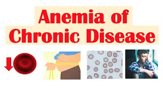 Anemia of Chronic Disease  Causes Pathophysiology Signs amp Symptoms Diagnosis Treatment [upl. by Adrienne]