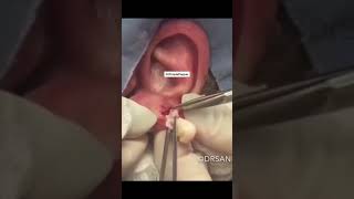 Dr Pimple Popper FIGHTS Epidhermoid Cyst ☄️ drpimplepopper [upl. by Hillari366]