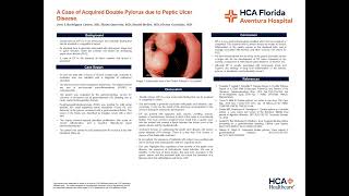 A Case of Acquired Double Pylorus due to Peptic Ulcer Disease [upl. by Mloc337]