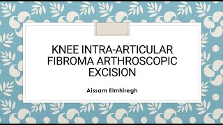 Knee intraarticular fibroma arthroscopic excision [upl. by Esydnac396]