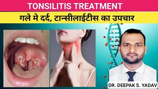 TONSILITIS CAUSES SINGS amp SYMPTOMS TREATMENT tonsillitis treatmentoftonsilitis [upl. by Ainalem]