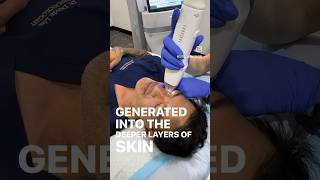 RF Microneedling to regenerate Collagen [upl. by Ayiak]