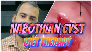 Nabothian Cyst DietWomen’s HealthControlling Ovarian Cyst [upl. by Elocim]