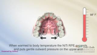 NiTi Palatal Expander  Orthodontics [upl. by Ewen340]