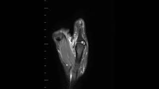 UCL rupture of thumb and Stener lesion [upl. by Droffilc696]