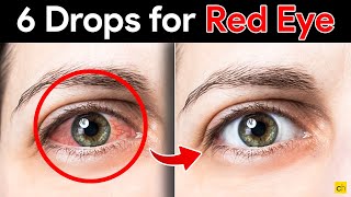 Fast and Effective 6 Eye Drops to Cure Red Eyes  Credihealth [upl. by Assil]