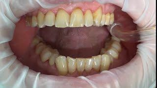 Dentistry  Scale Polish amp Tepe brushing ASMR [upl. by Jarrod]