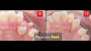 Treatment of palatal impaction [upl. by Jeraldine988]