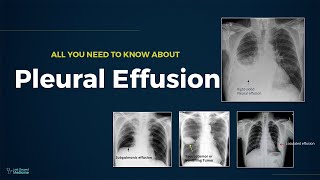 Consolidation vs Pleural Effusion [upl. by Ona]