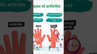 Arthritis  short  viral  medico  norcet [upl. by Alurd]