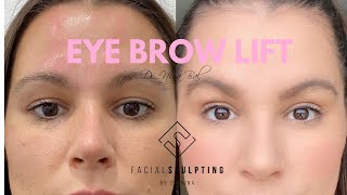 Eyebrow Lift Before And After with Dr Nina Bal 💗 Brow Lift London UK [upl. by Aseel]