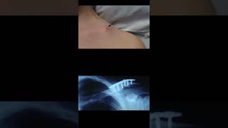 Broken Collarbone Clavicle Fracture [upl. by Skees]