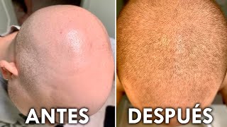 ¿El Secreto Para Recuperar Tu Pelo En 2 Meses [upl. by Avah]