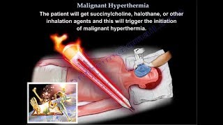 Malignant Hyperthermia  Everything You Need To Know  Dr Nabil Ebraheim [upl. by Lexine]