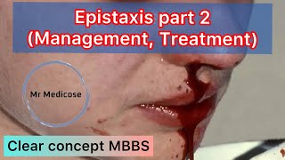 Epistaxis part 2 Management Treatment [upl. by Ahl]