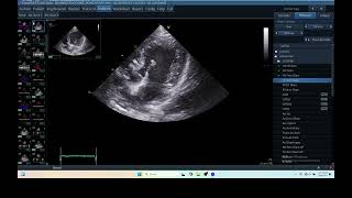 IQ 279 HEMODYNAMIC ECHOPAC ANALYSIS ECHOCARDIOGRAPHY HEPATOMA [upl. by Nnylhtak286]