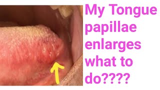 Enlarged tongue papillaeFoliate papillae enlarges whyI have enlarged tongue Papillae what to do [upl. by Wally]